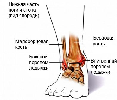 ankle-fracture.jpg